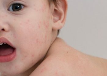 Begini Menghilangkan Bekas Cacar Air