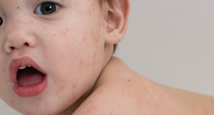 Begini Menghilangkan Bekas Cacar Air