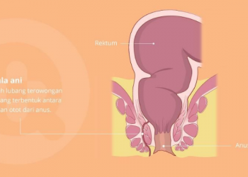 Mengenal Fistula Ani, Penyakit yang Bikin Nyeri saat BAB