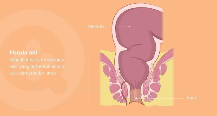 Mengenal Fistula Ani, Penyakit yang Bikin Nyeri saat BAB