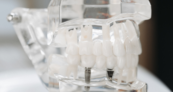 Gigi Tonggos, Perlukah Dicabut?