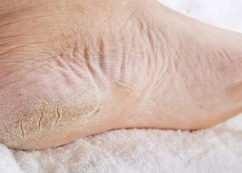 6 Cara Mudah Atasi Kaki Pecah-Pecah