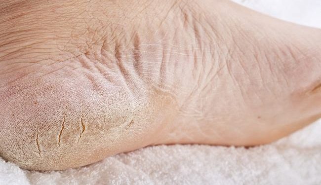 6 Cara Mudah Atasi Kaki Pecah-Pecah