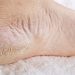 6 Cara Mudah Atasi Kaki Pecah-Pecah