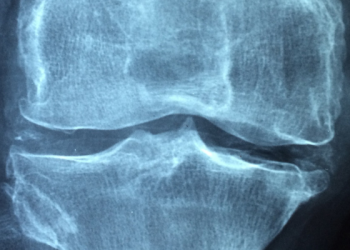 Mengenal Penyakit Rematik