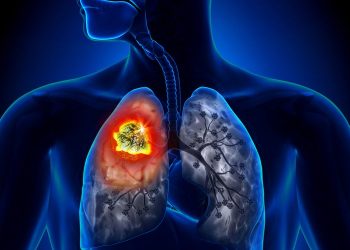 Waspada Kanker Paru karena Tak Bergejala