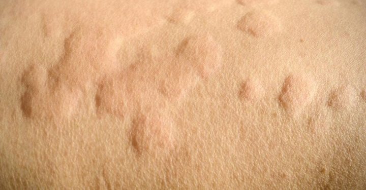 Ini Gejala Jika Kulitmu Alergi Kosmetik