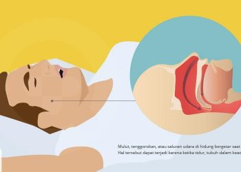 Teknologi Ini Bisa Kecilkan Suara Dengkuran