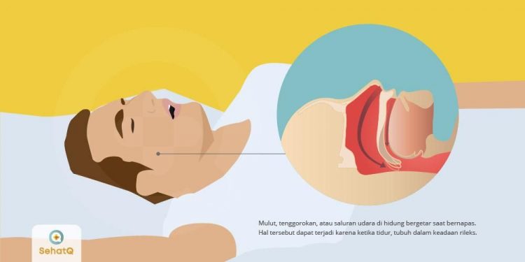 Teknologi Ini Bisa Kecilkan Suara Dengkuran