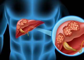 Ini Ciri Orang yang Beresiko Terkena Kanker Hati