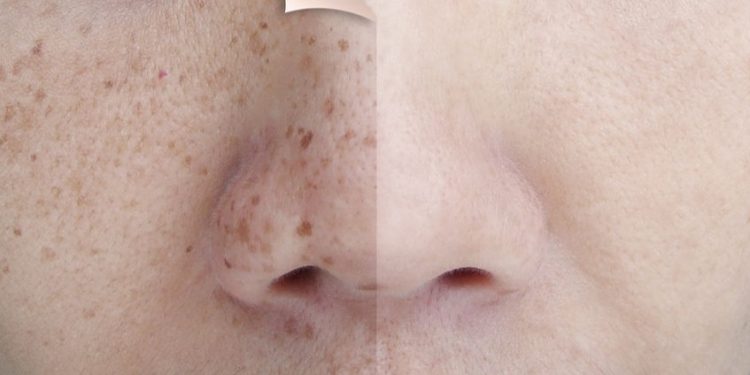 Flek Hitam di Wajah Tak Kunjung Hilang? Cari tahu Sebabnya di sini