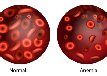 Dengan 5L, Kenali Gejala Anemia