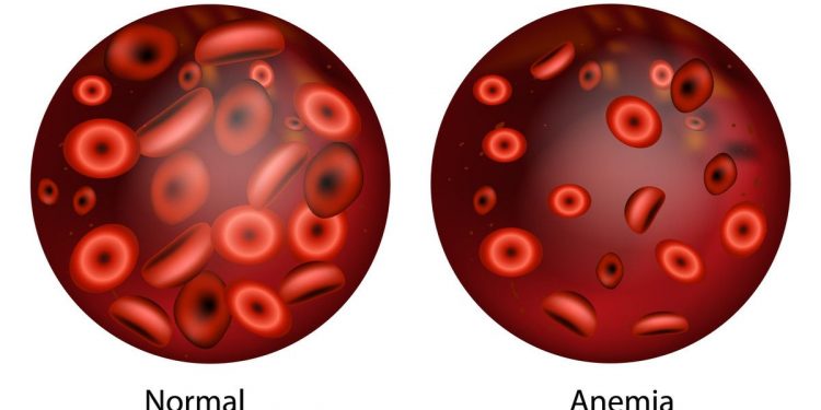 Dengan 5L, Kenali Gejala Anemia