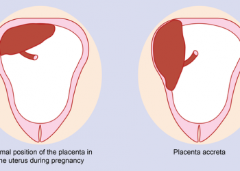 Kondisi Plasenta Akreta, Bisakah Melahirkan Normal?