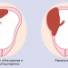Kondisi Plasenta Akreta, Bisakah Melahirkan Normal?