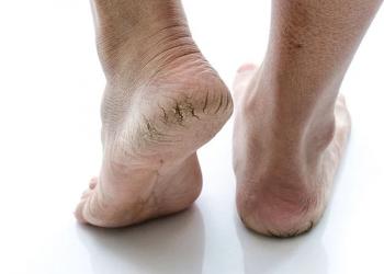 Tip Agar Tumit Tak Bersisik