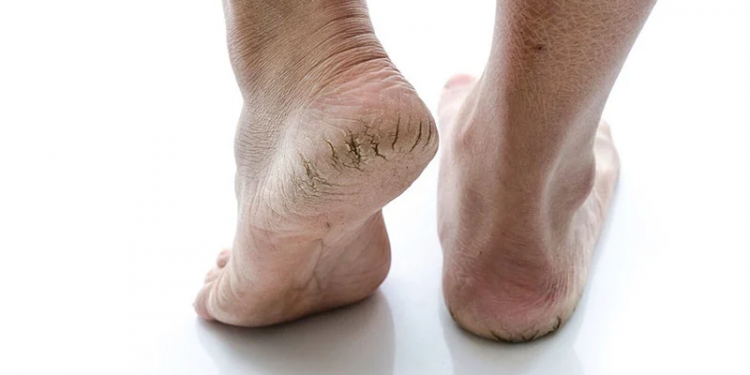 Tip Agar Tumit Tak Bersisik