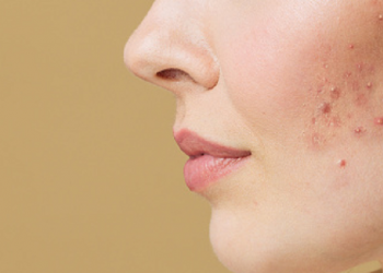Kenali Jerawat Hormon dan Cara Mengatasinya