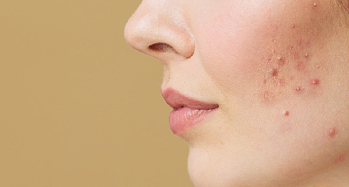 Kenali Jerawat Hormon dan Cara Mengatasinya
