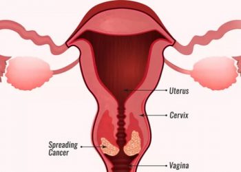 Sering Keputihan? Waspadai Gejala Kanker Serviks Ini