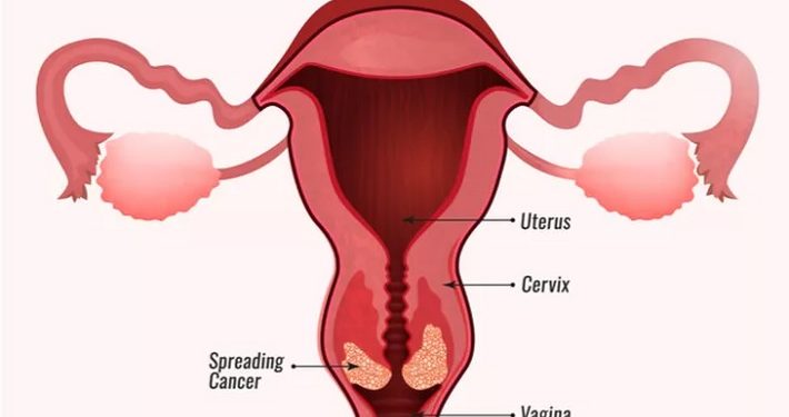 Sering Keputihan? Waspadai Gejala Kanker Serviks Ini