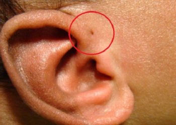 Penyebab Anak Memiliki Lubang Kecil di Dekat Telinga