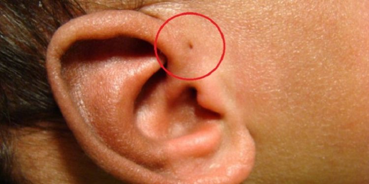 Penyebab Anak Memiliki Lubang Kecil di Dekat Telinga
