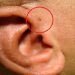 Penyebab Anak Memiliki Lubang Kecil di Dekat Telinga