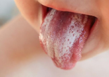 Timbul Bercak Putih di Mulut Bayi, Ini Penjelasan Ilmiahnya