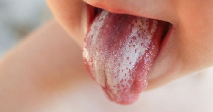 Timbul Bercak Putih di Mulut Bayi, Ini Penjelasan Ilmiahnya