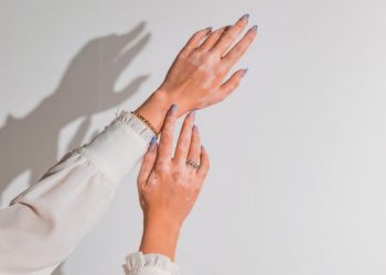 Cara mengatasi vitiligo di wajah