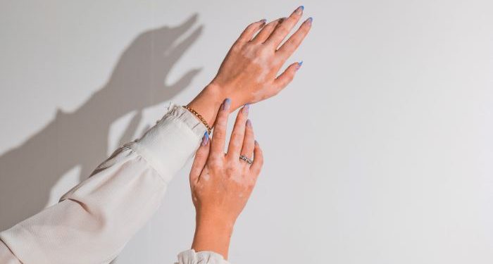 Cara mengatasi vitiligo di wajah