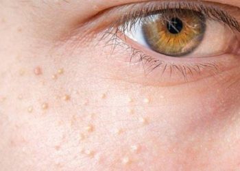 Milia Hilang dengan Minyak Jarak