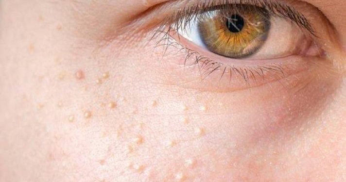 Milia Hilang dengan Minyak Jarak