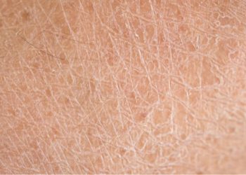 Penyebab Kulit Kering