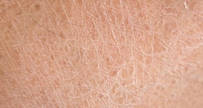 Penyebab Kulit Kering