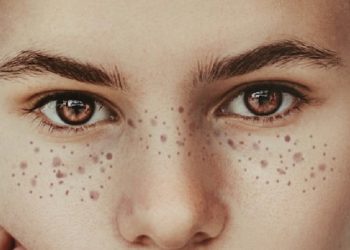 Hilangkan Flek Hitam Bekas Jerawat dengan Lidah Buaya dan Lemon