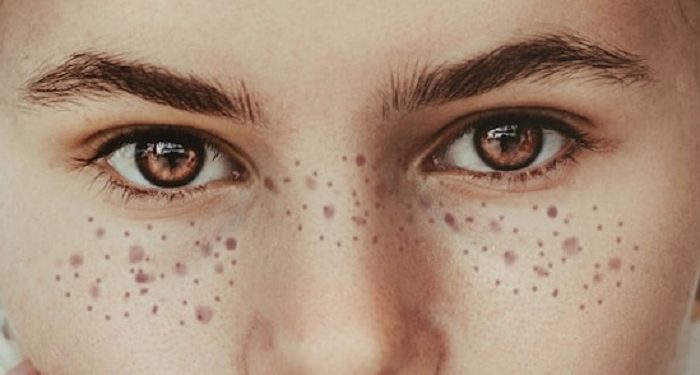 Hilangkan Flek Hitam Bekas Jerawat dengan Lidah Buaya dan Lemon