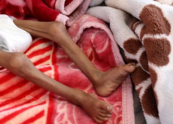 400 Ribu Anak Yaman di Bawah 5 Tahun dalam Bahaya Kematian Akibat Kekurangan Gizi Akut