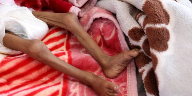 400 Ribu Anak Yaman di Bawah 5 Tahun dalam Bahaya Kematian Akibat Kekurangan Gizi Akut
