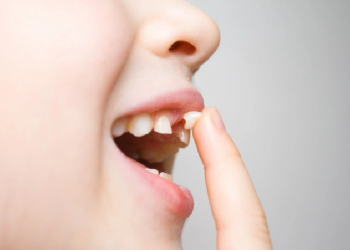 Mitos dan Fakta Seputar Pertumbuhan Gigi Anak (2)