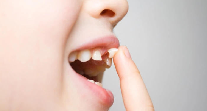 Mitos dan Fakta Seputar Pertumbuhan Gigi Anak (2)