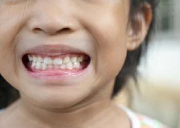 Mitos dan Fakta Seputar Pertumbuhan Gigi Anak (1)