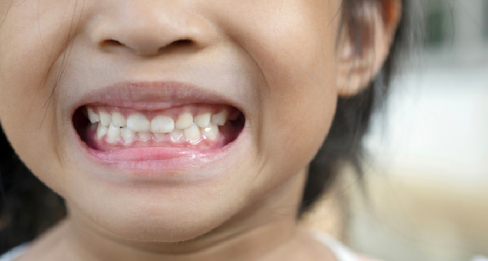 Mitos dan Fakta Seputar Pertumbuhan Gigi Anak (1)