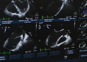 Manfaat Melakukan USG Pada Ibu Hamil