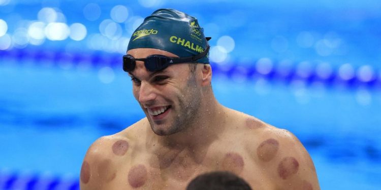 Olimpiade Tokyo: Mengapa Beberapa Atlet Melakukan Bekam?