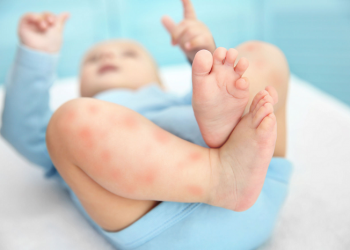 Beberapa Faktor Alergi Pada Bayi