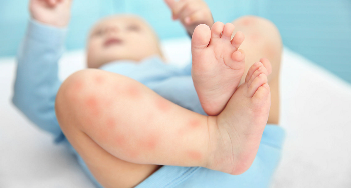 Beberapa Faktor Alergi Pada Bayi