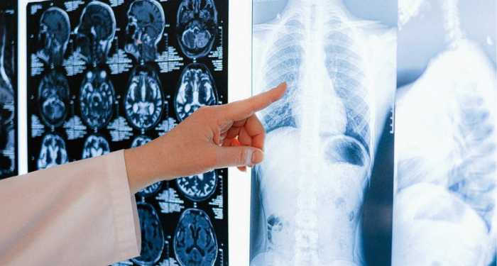 Cara Memeriksa Kesehatan Paru-paru