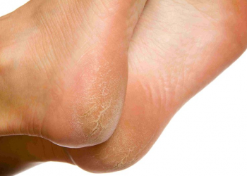 Telapak Kaki Kasar dan Kering, Ini Solusinya